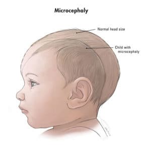Microcephaly-B