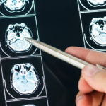 Millennial Magazine - health - dendritic cell therapy for brain tumors