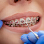 Millennial Magazine- Health- Oral Hygiene- Orthodontic treatments