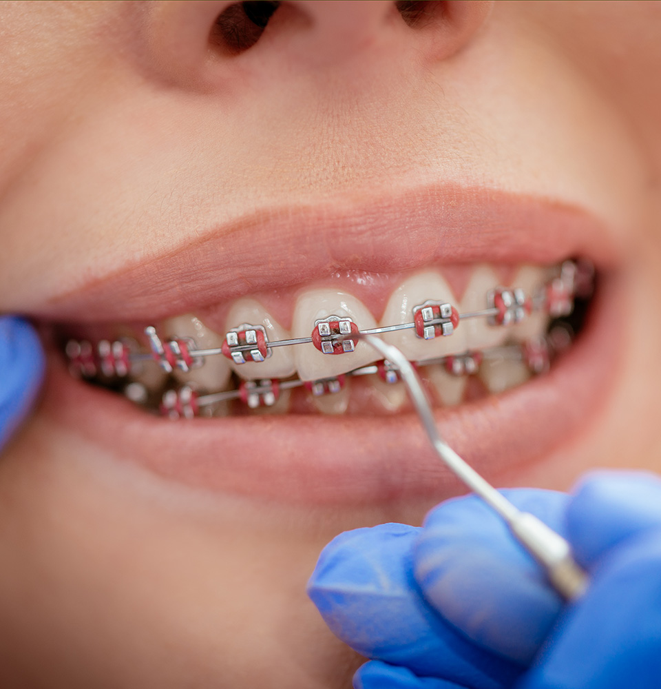 Millennial Magazine- Health- Oral Hygiene- Orthodontic treatments